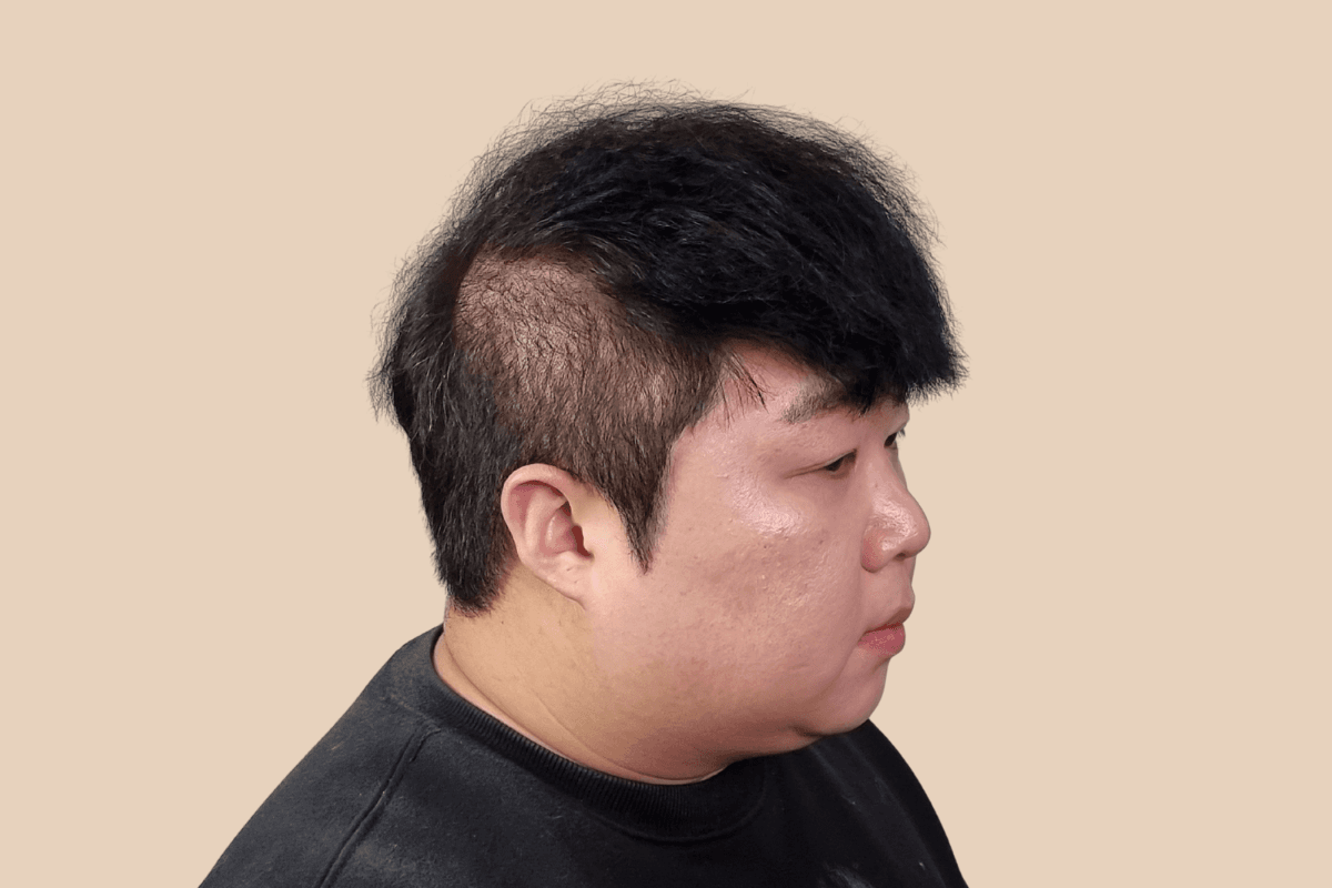 측두부 밀도를 자연스럽게 보완한 사례 비포