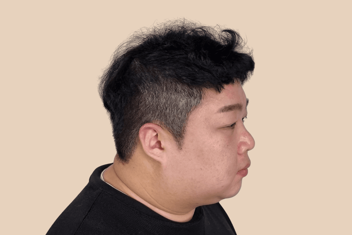 측두부 밀도를 자연스럽게 보완한 사례 애프터