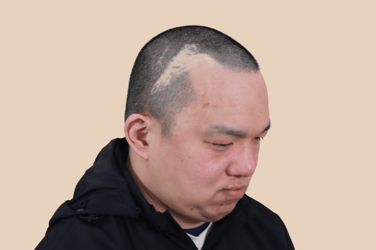 화상 수술 등으로 생긴 두피 흉터를 도팅으로 커버한 사례 비포