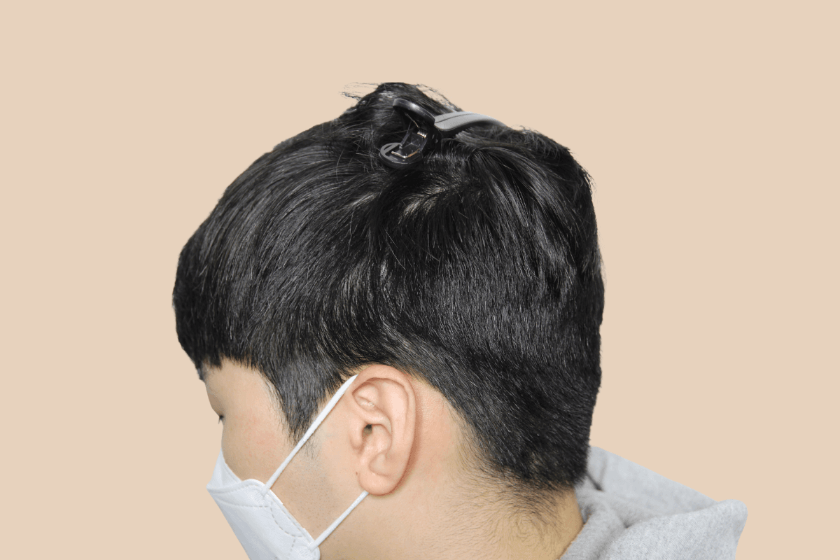 화상 수술 등으로 생긴 두피 흉터를 도팅으로 커버한 사례 애프터
