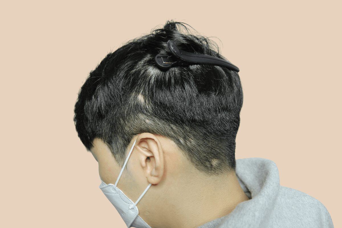 화상 수술 등으로 생긴 두피 흉터를 도팅으로 커버한 사례 비포