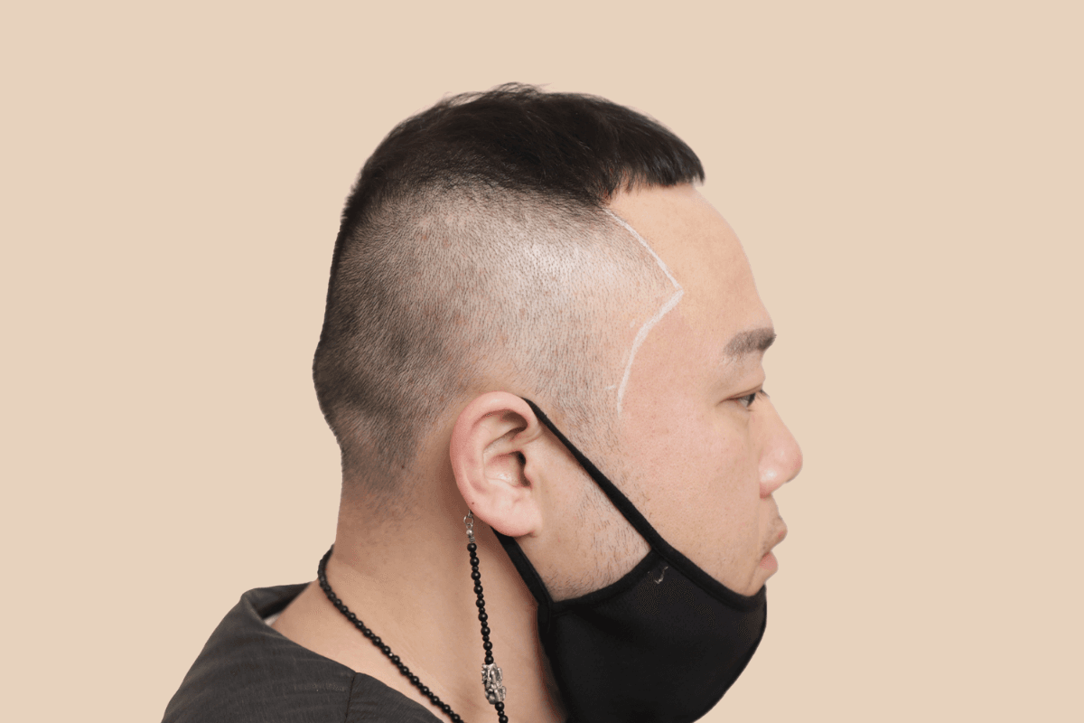 측두부 밀도를 자연스럽게 보완한 사례 비포