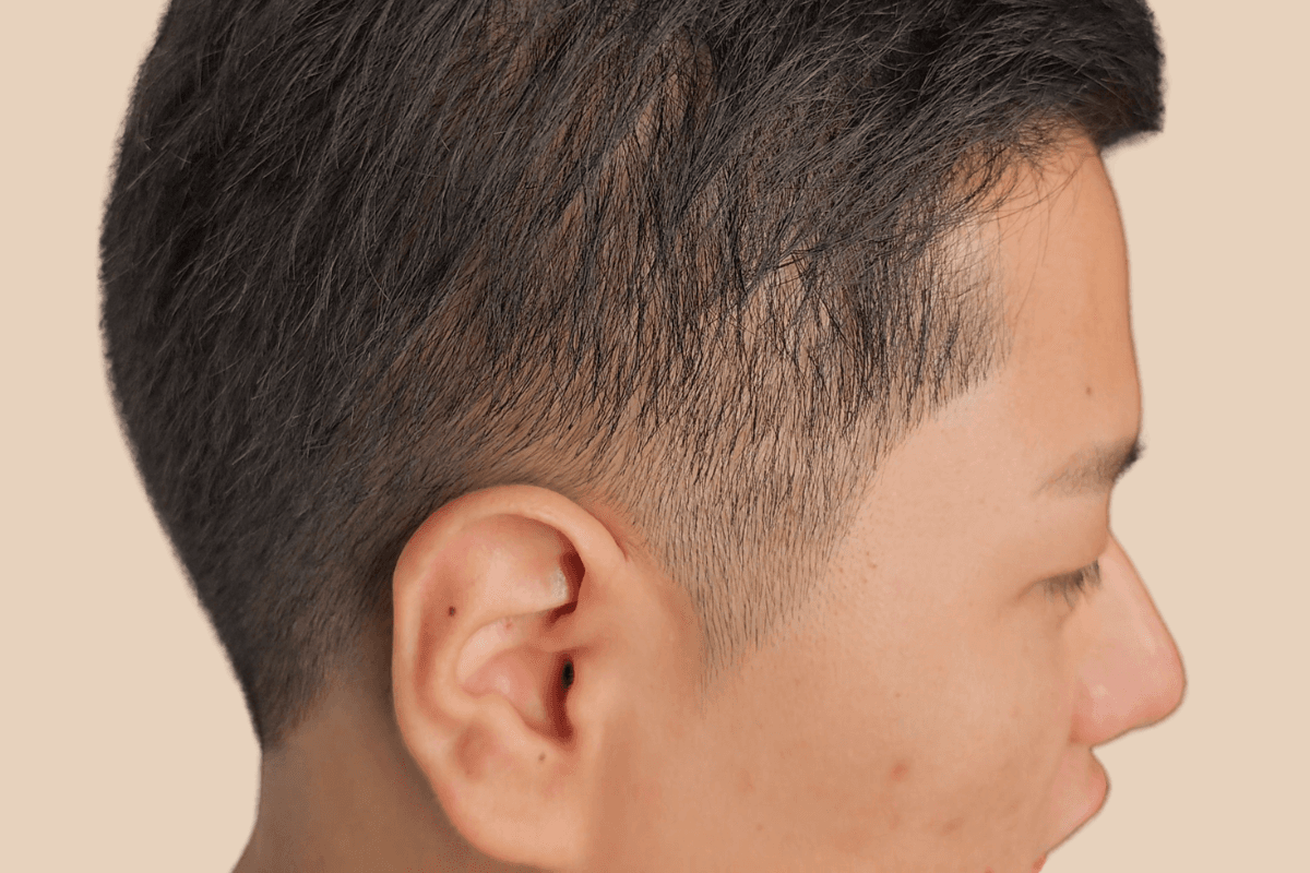 측두부 밀도를 자연스럽게 보완한 사례 비포
