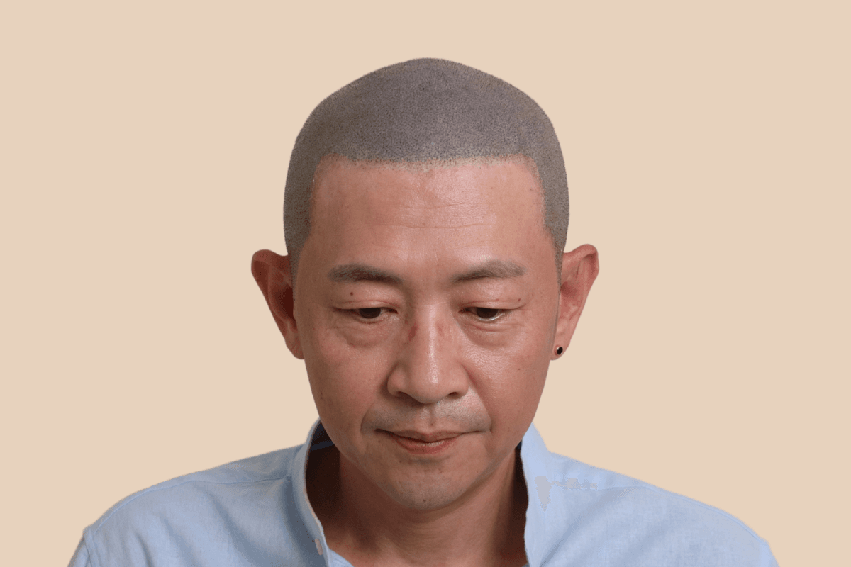 타 업체 시술 후 어색해진 두피를 자연스럽게 재교정한 사례 애프터
