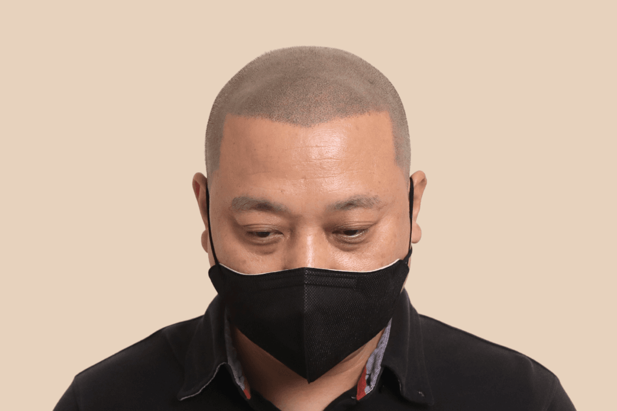 타 업체 시술 후 어색해진 두피를 자연스럽게 재교정한 사례 애프터
