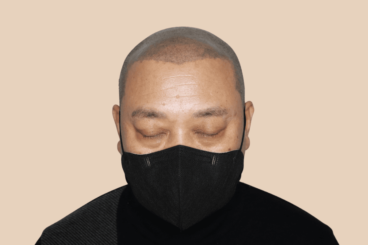 타 업체 시술 후 어색해진 두피를 자연스럽게 재교정한 사례 비포