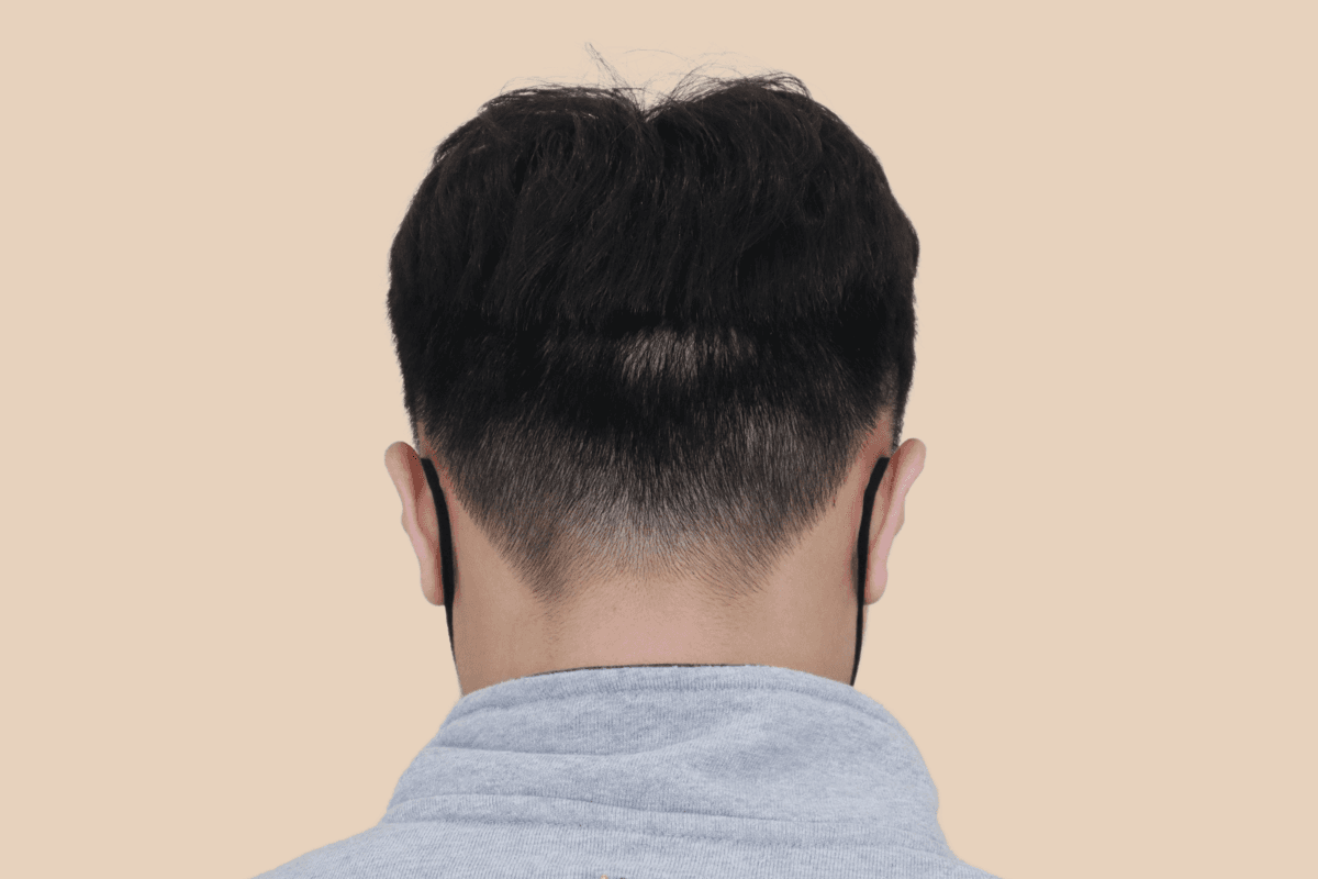 절개 비절개 모발이식 흉터를 모근 음영으로 커버한 사례 비포