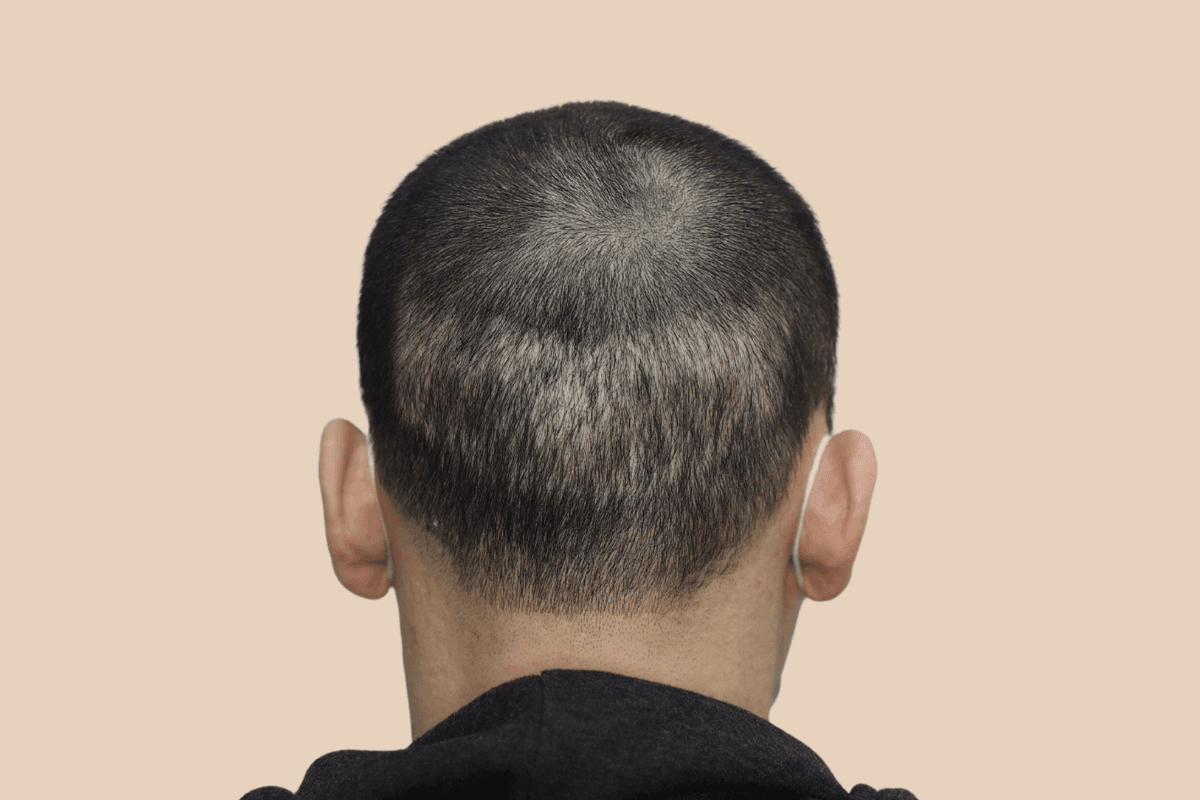 절개 비절개 모발이식 흉터를 모근 음영으로 커버한 사례 비포