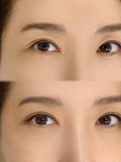 ベーシックアイライン 施術写真
