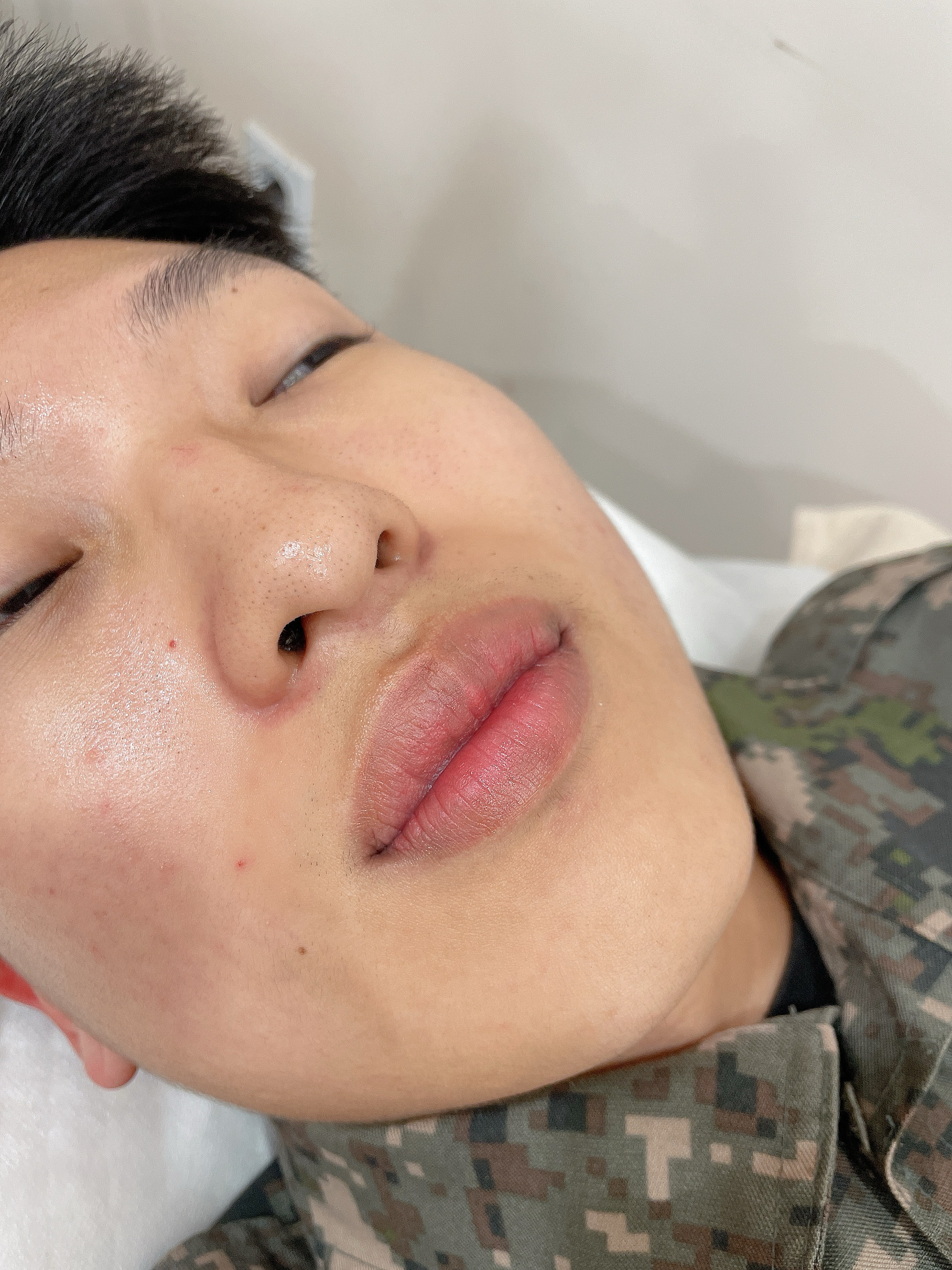 어보브나인 다크립 교정 after
