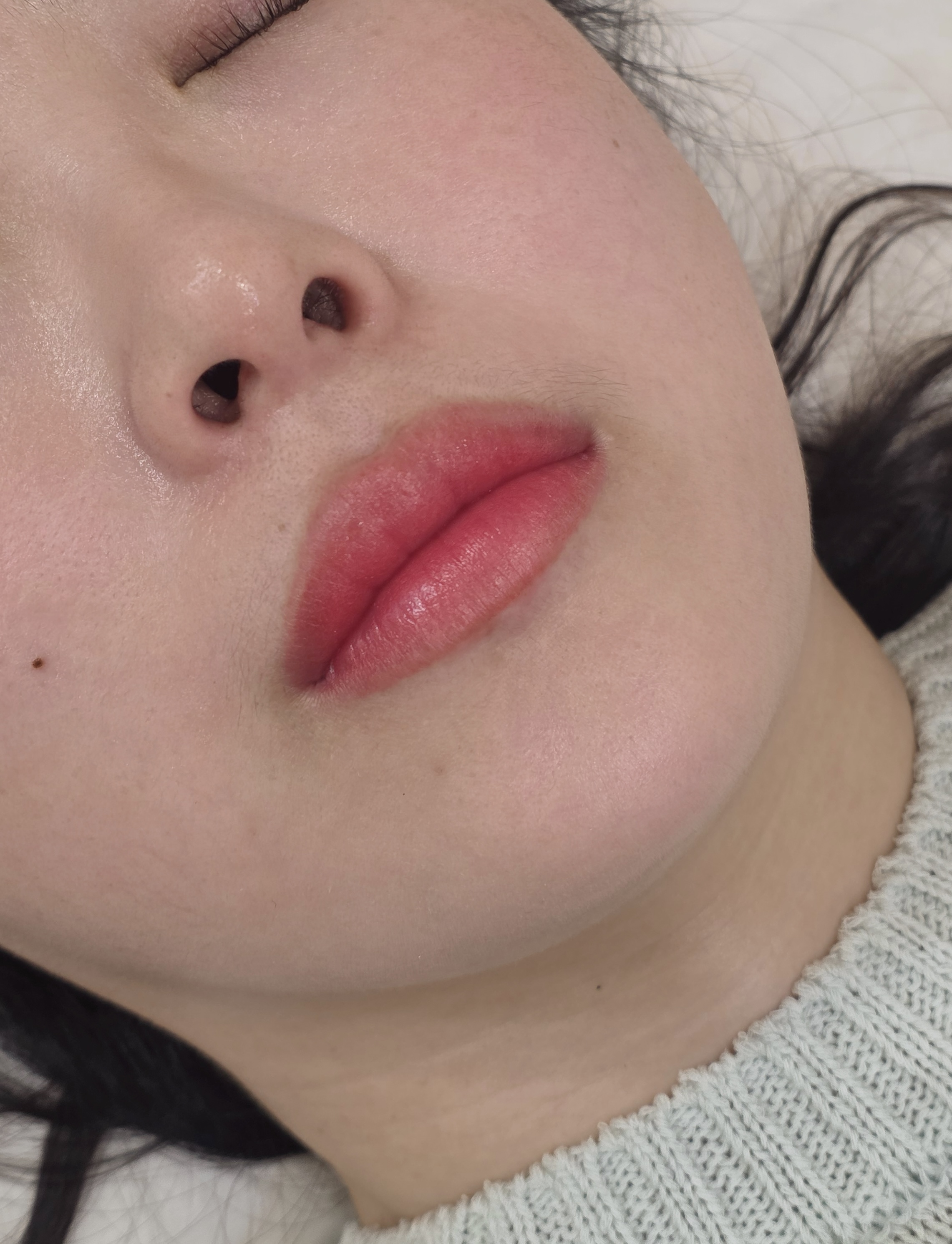 다크립 교정 애프터
