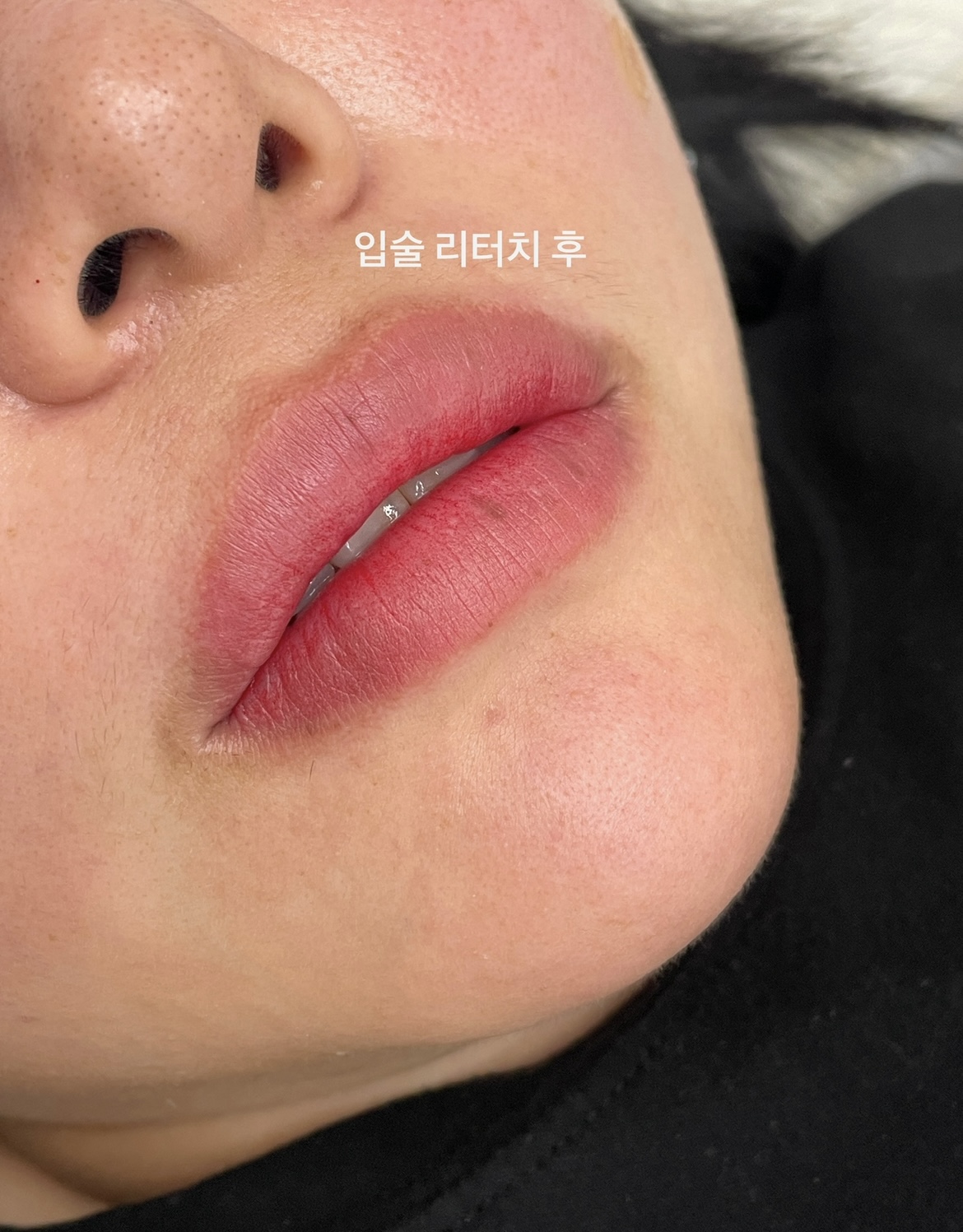 풀커버 애프터