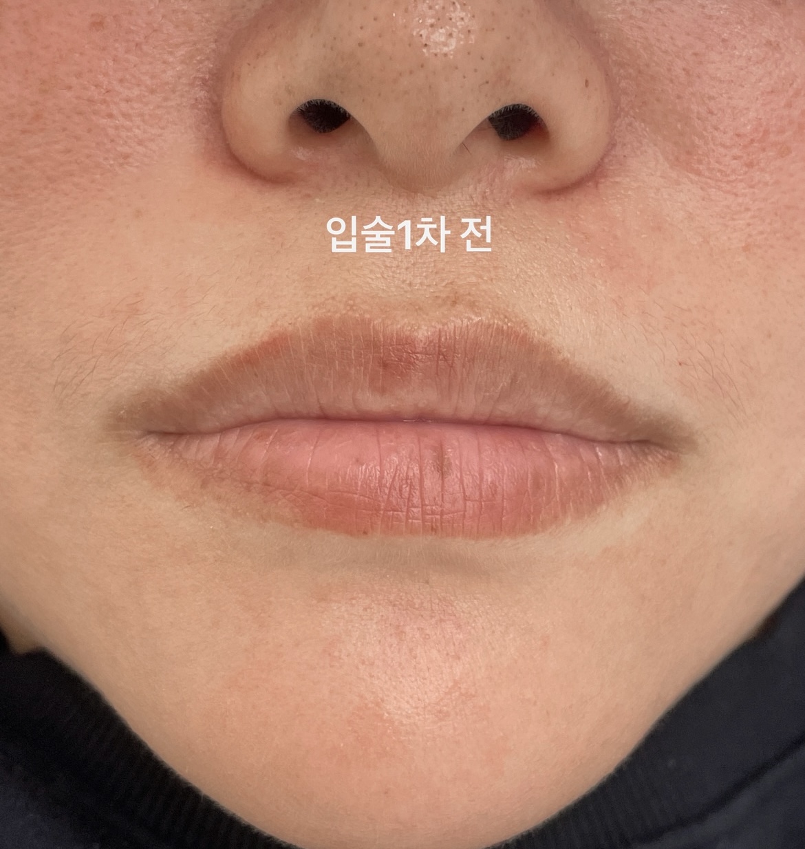 풀커버 비포