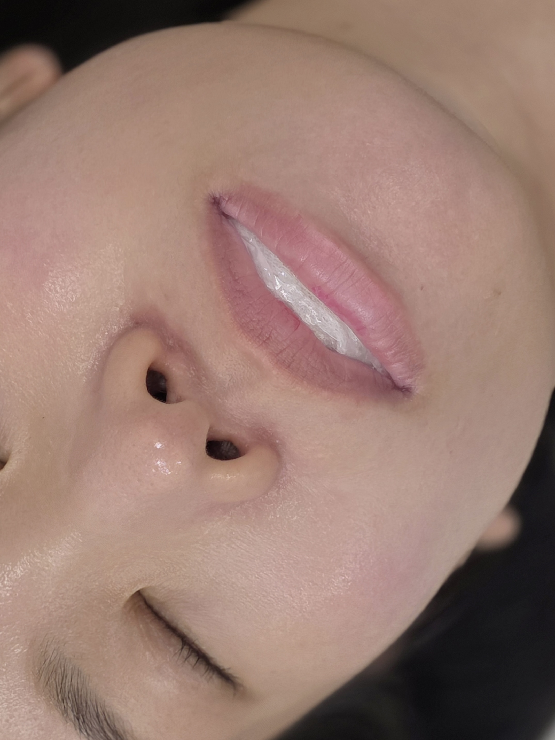 어보브나인 립라인 확장 before