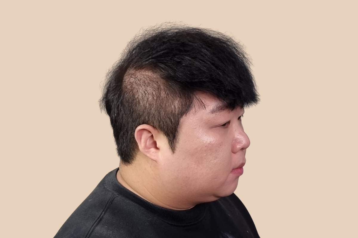 측두부 밀도를 자연스럽게 보완한 사례 시술 전