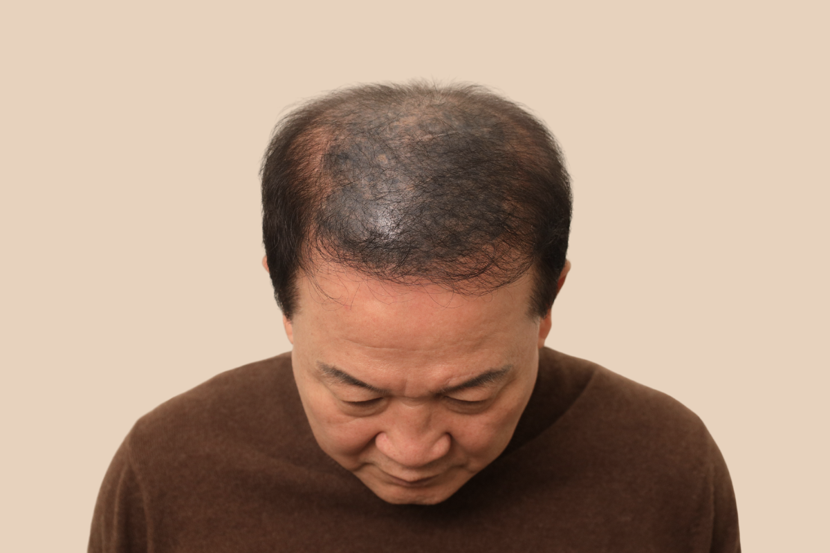 특수부위 시술 전