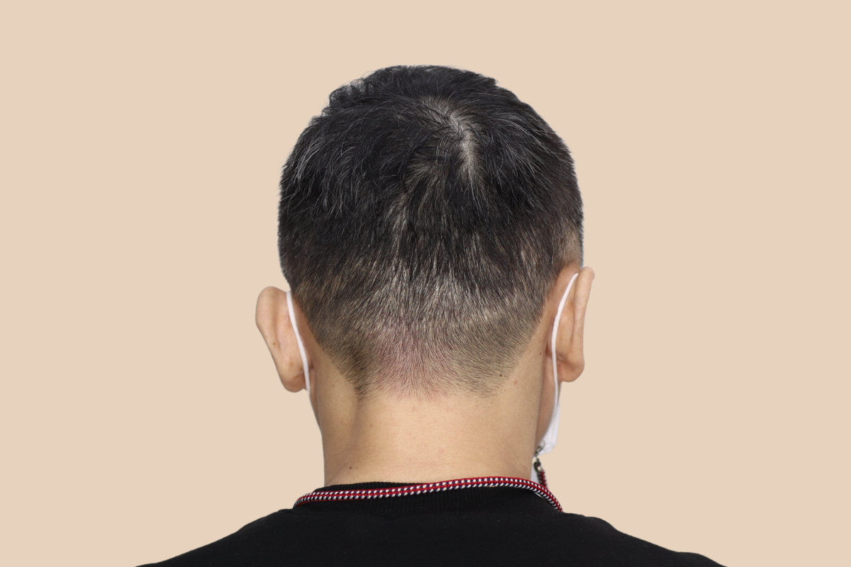 절개 · 비절개 모발이식 흉터를 모근 음영으로 커버한 사례 시술 전