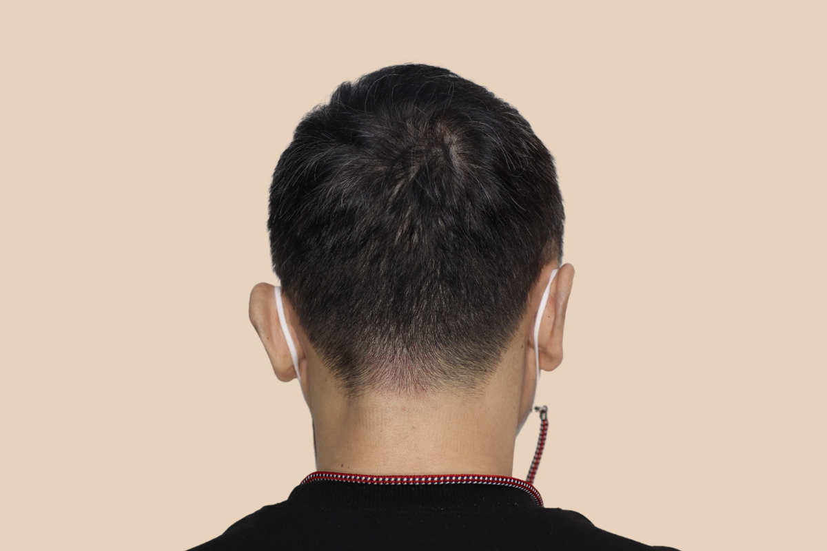 절개 · 비절개 모발이식 흉터를 모근 음영으로 커버한 사례 3회 시술 후