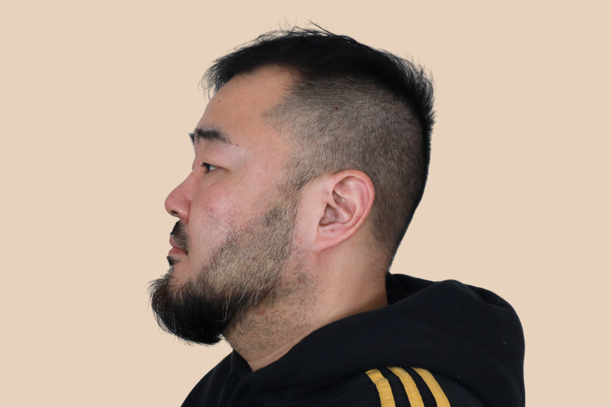 구레나룻 · 턱수염 라인을 또렷하게 디자인한 사례 3회 시술 후