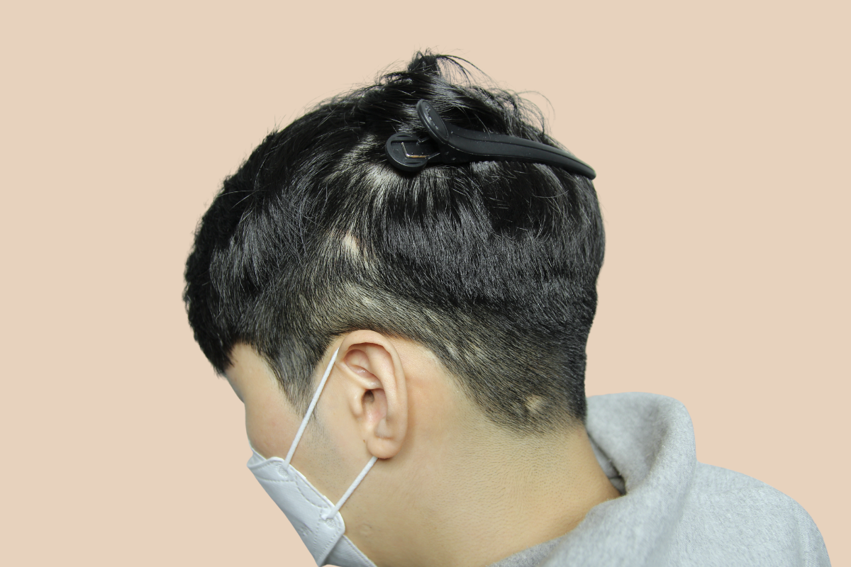화상 · 수술 등으로 생긴 두피 흉터를 도팅으로 커버한 사례 시술 전