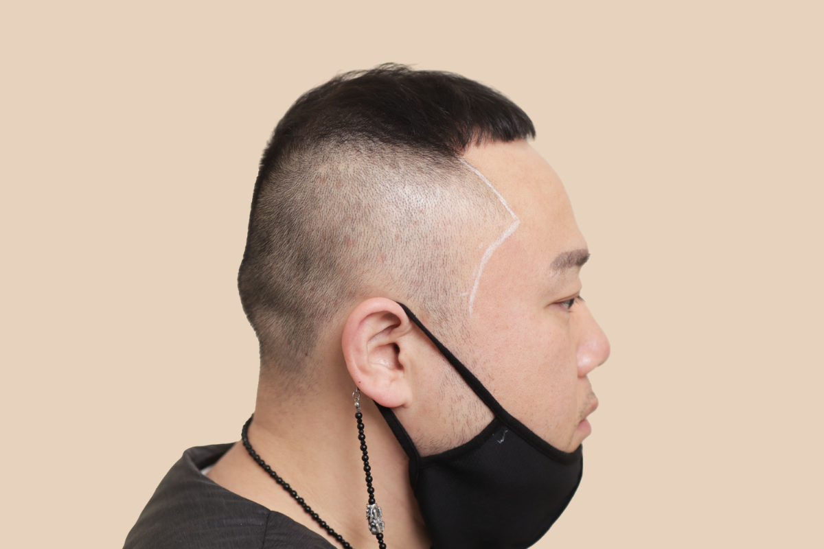 측두부 밀도를 자연스럽게 보완한 사례 시술 전