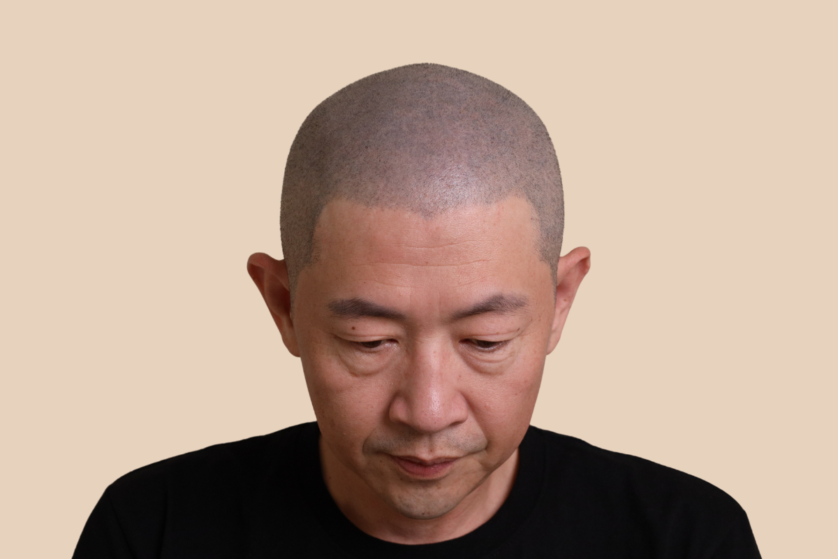 특수부위 시술 전