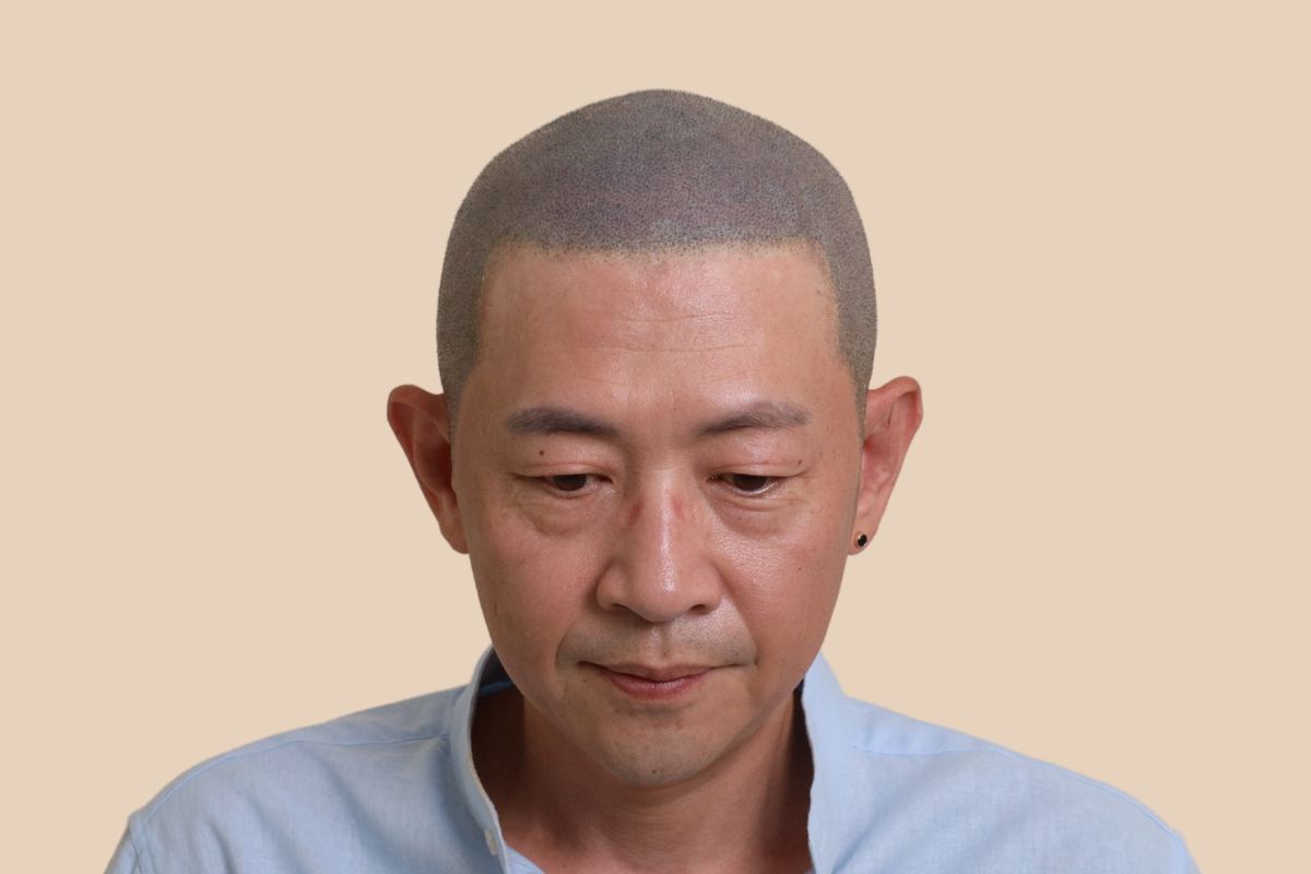 특수부위 4회 시술 후