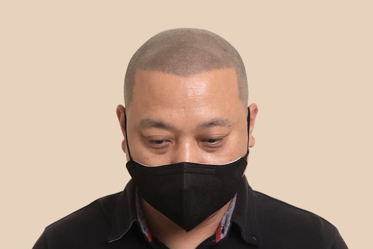 특수부위 4회 시술 후