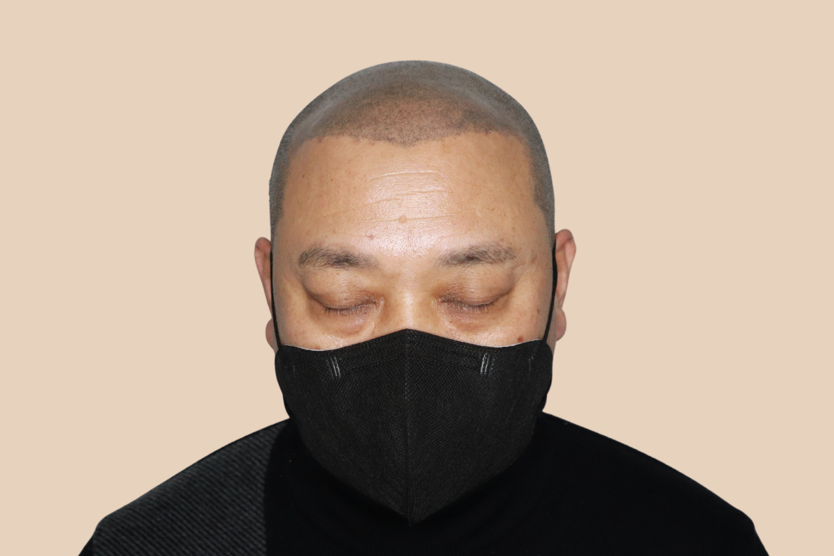 특수부위 시술 전