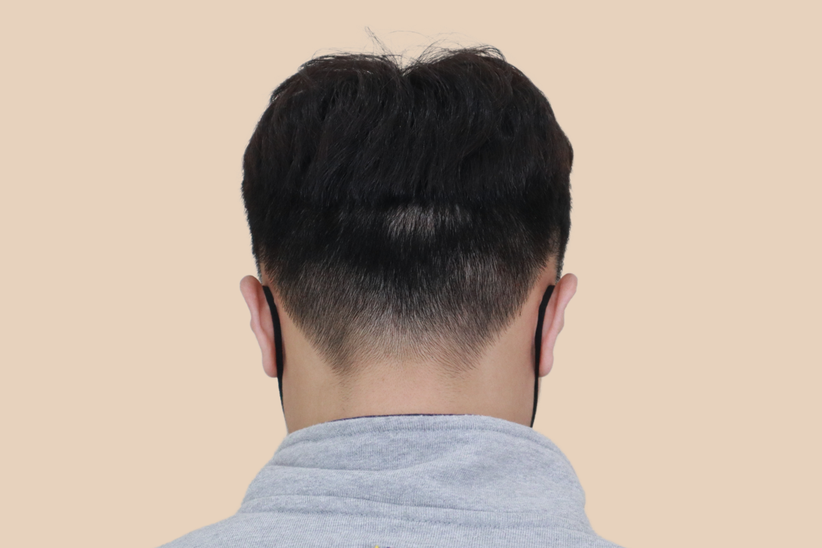 절개 · 비절개 모발이식 흉터를 모근 음영으로 커버한 사례 시술 전