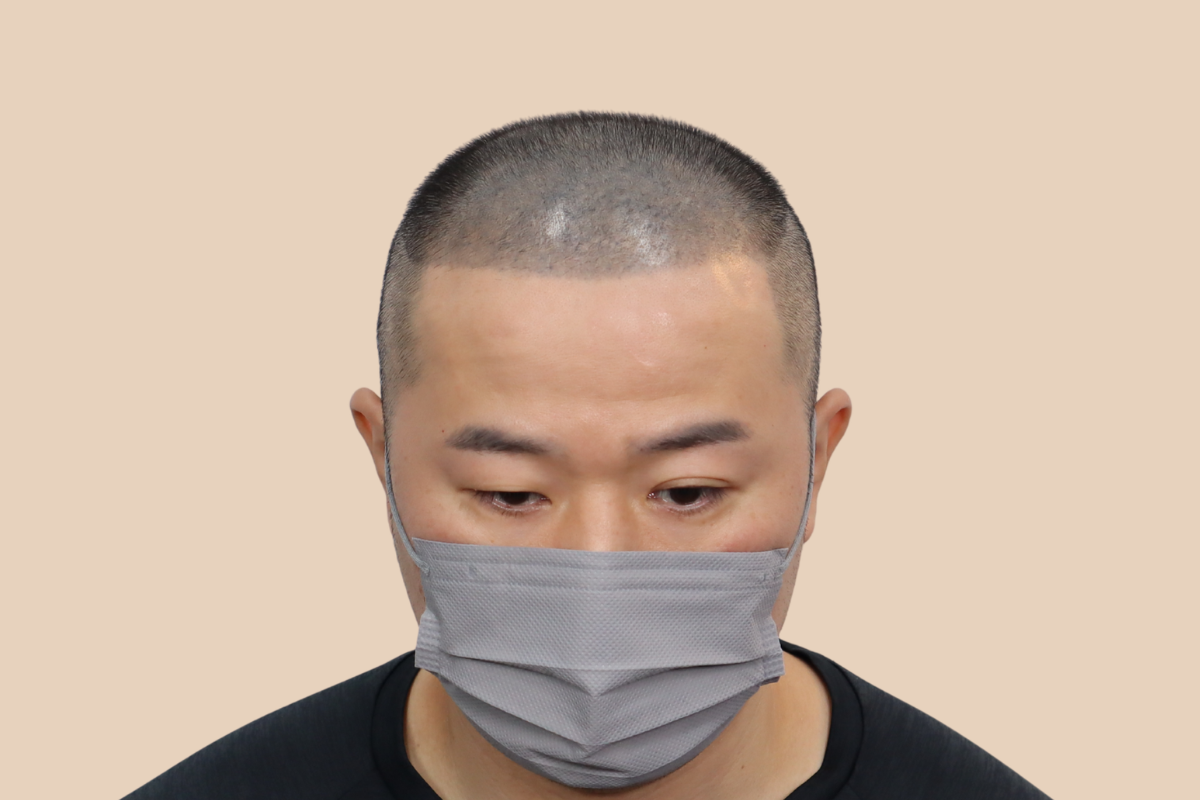 타 업체 시술 후 어색해진 두피를 자연스럽게 재교정한 사례 시술 전