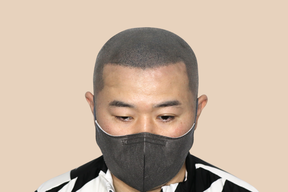 타 업체 시술 후 어색해진 두피를 자연스럽게 재교정한 사례 4회 시술 후