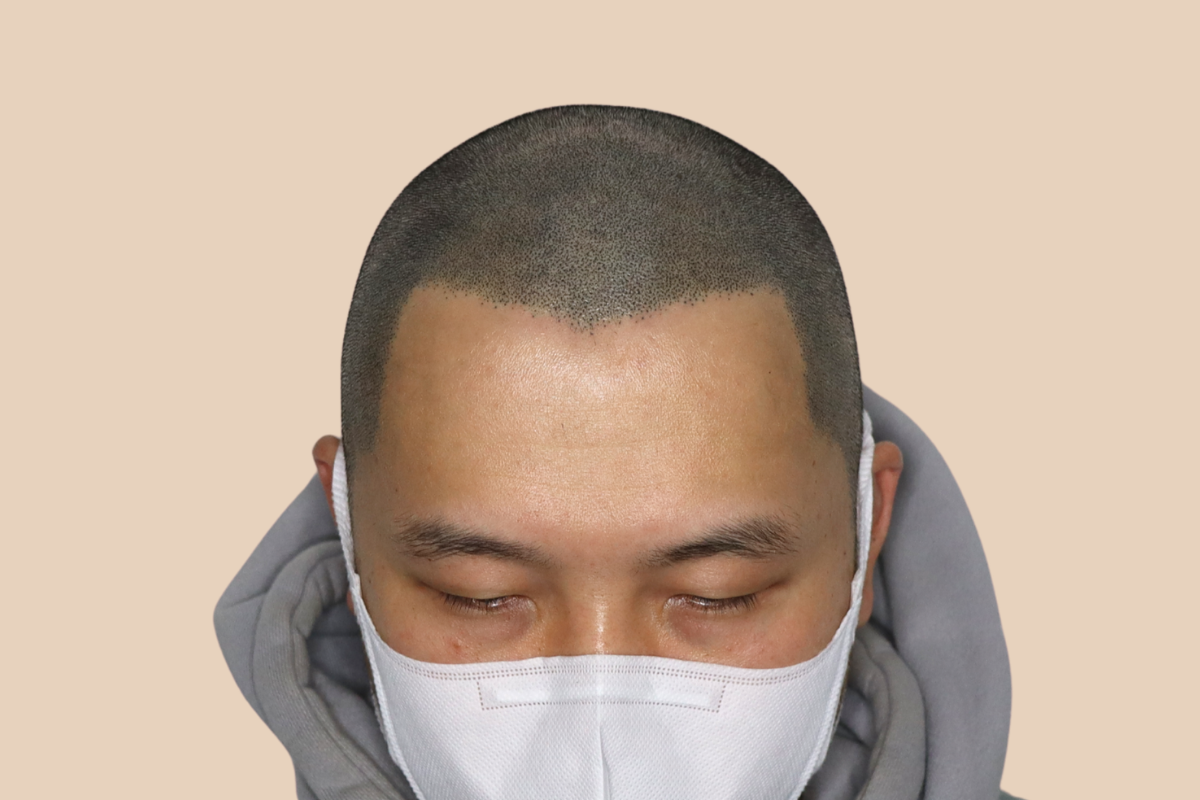 삭발디자인 시술 후