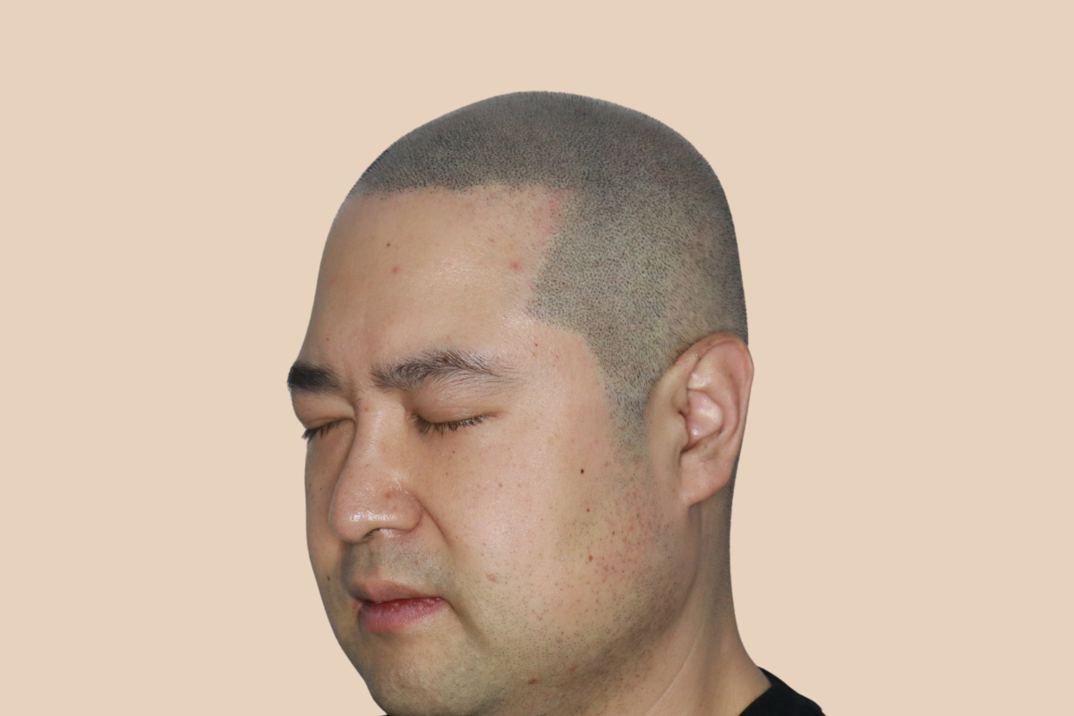삭발디자인 5회 시술 후