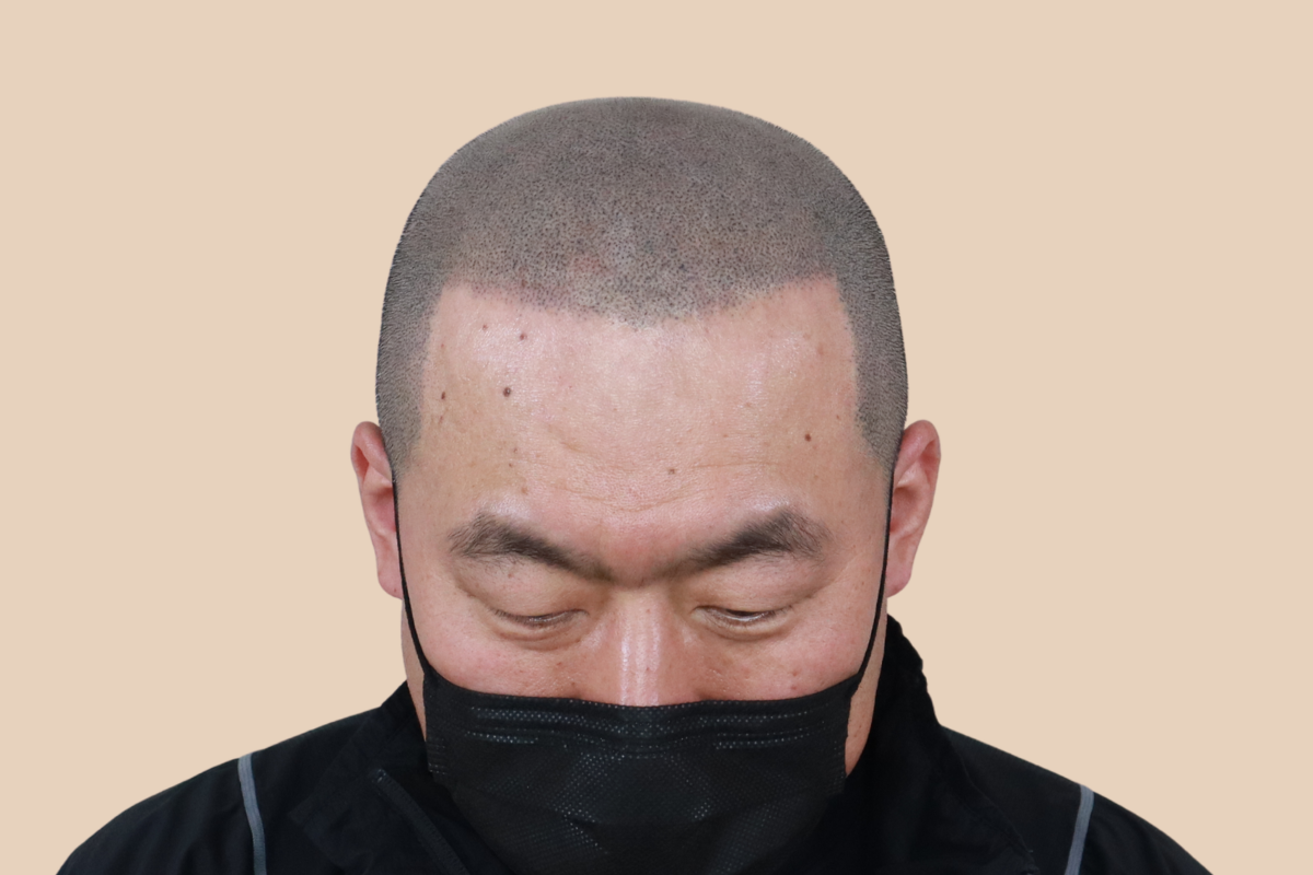 삭발디자인 4회 시술 후