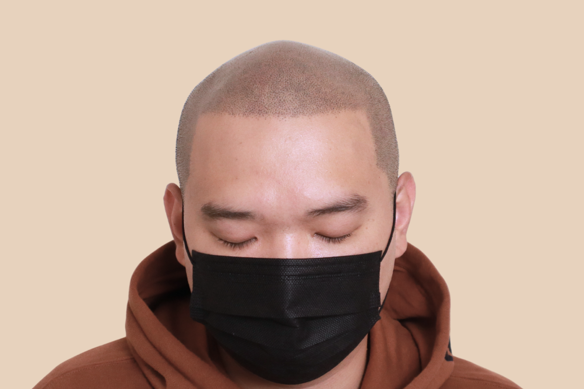 삭발디자인 5회 시술 후