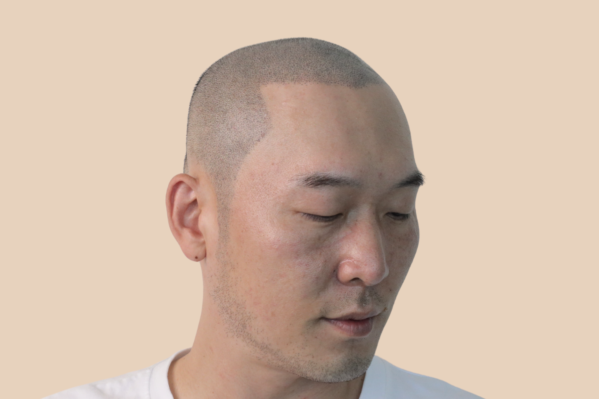 삭발디자인 5회 시술 후