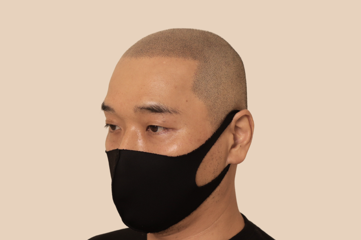 삭발디자인 5회 시술 후