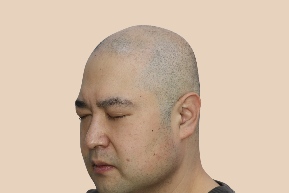 삭발디자인 시술 전