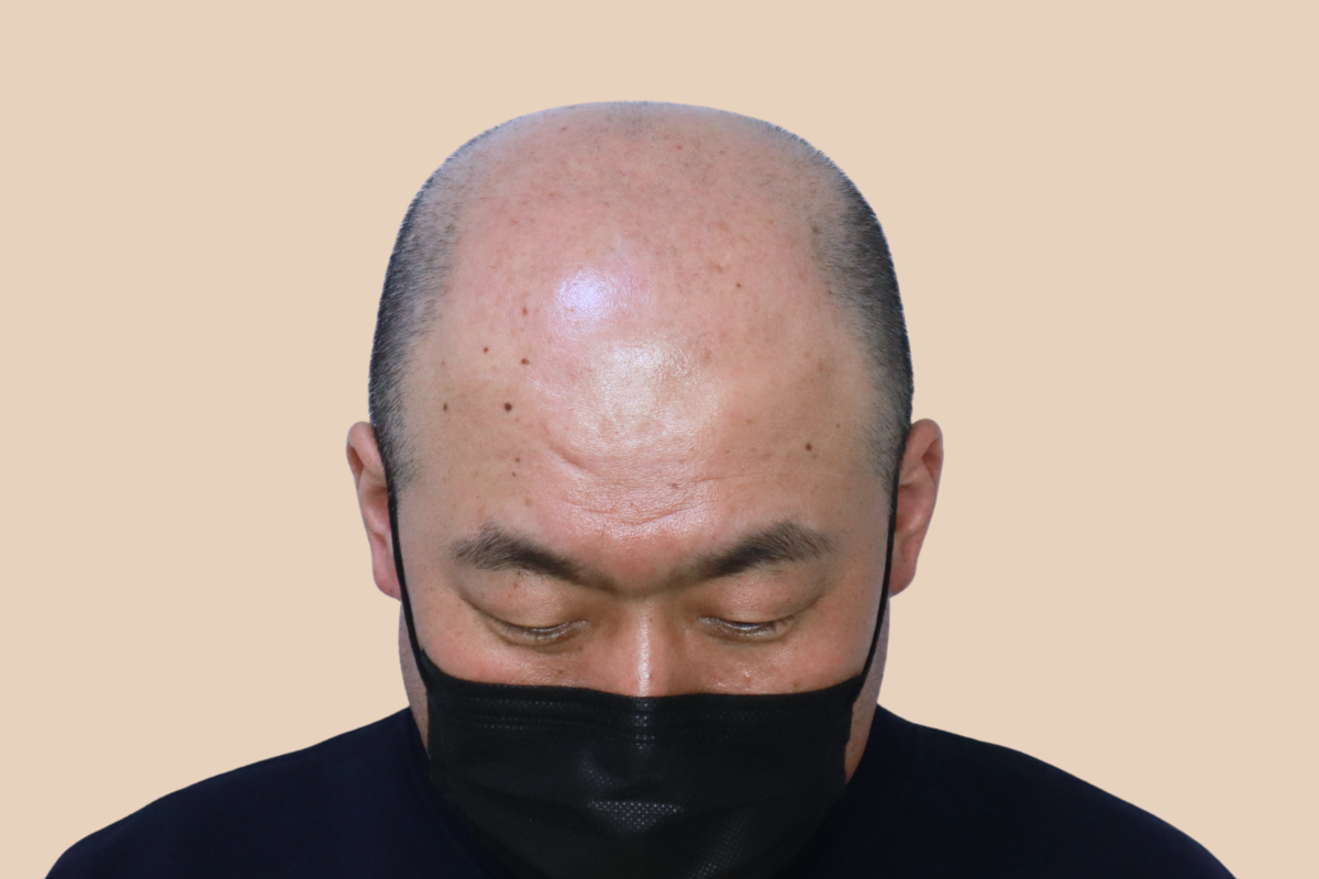 삭발디자인 시술 전