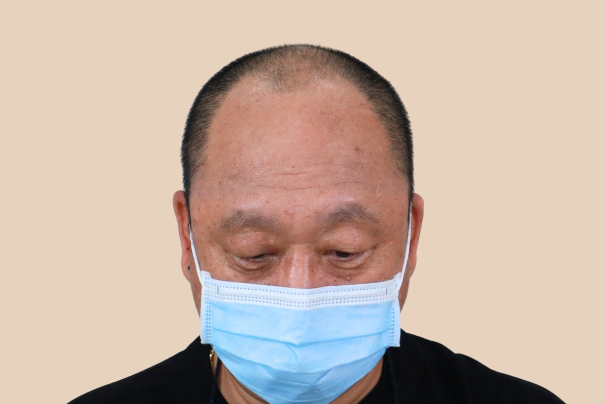 삭발디자인 시술 전