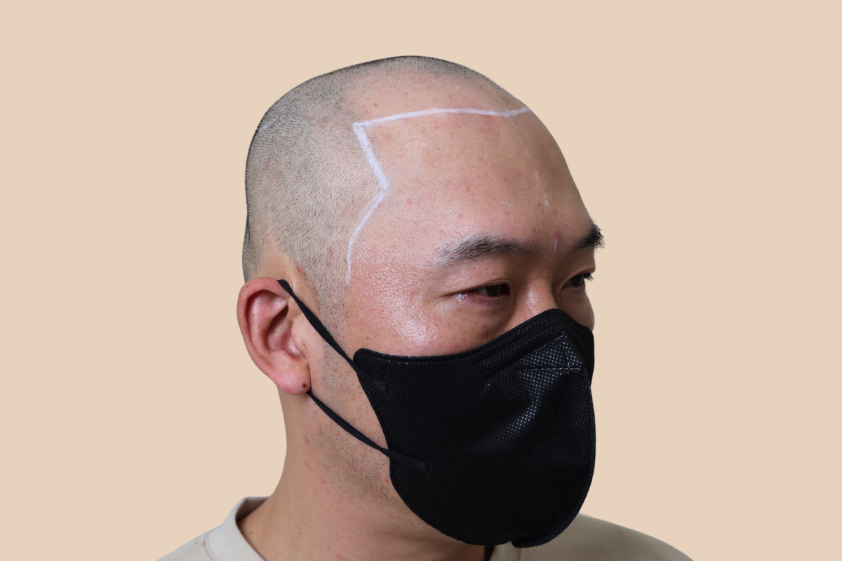 삭발디자인 시술 전