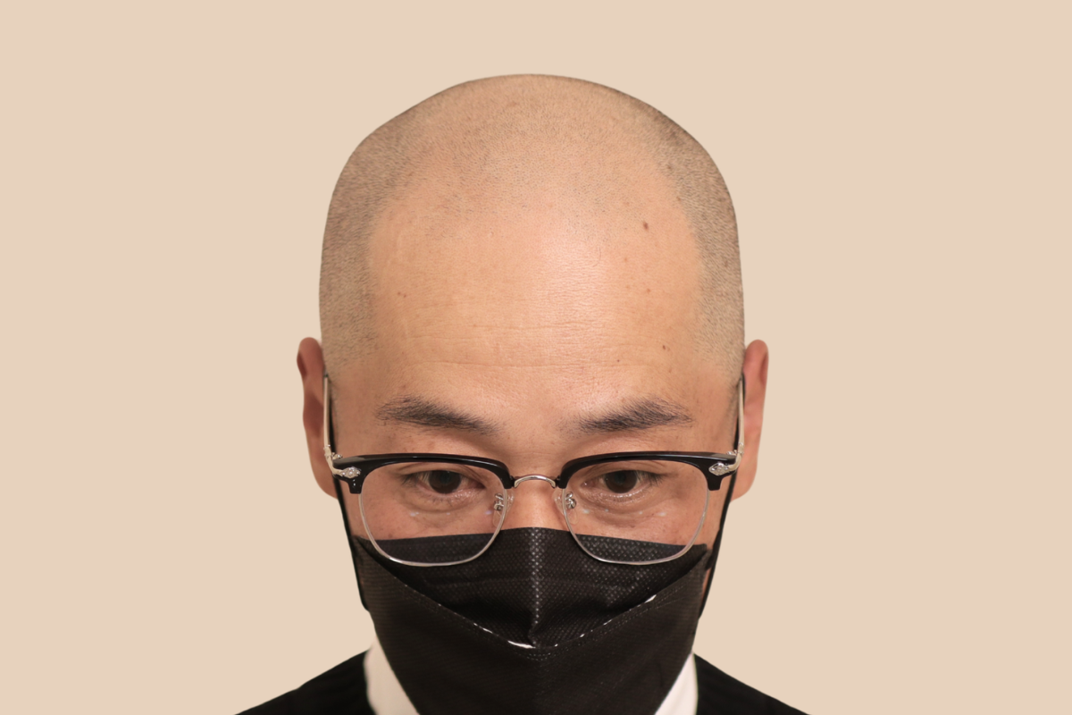 삭발디자인 시술 전