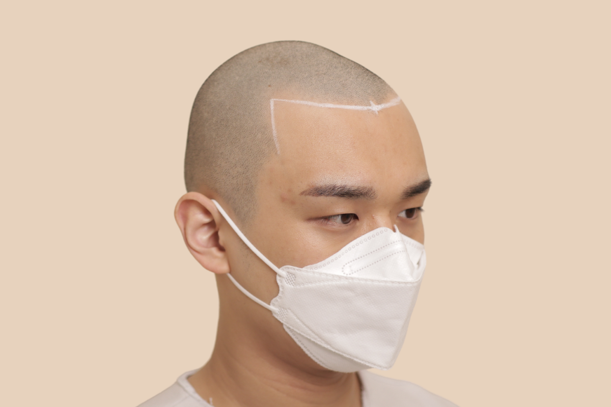 삭발디자인 시술 전