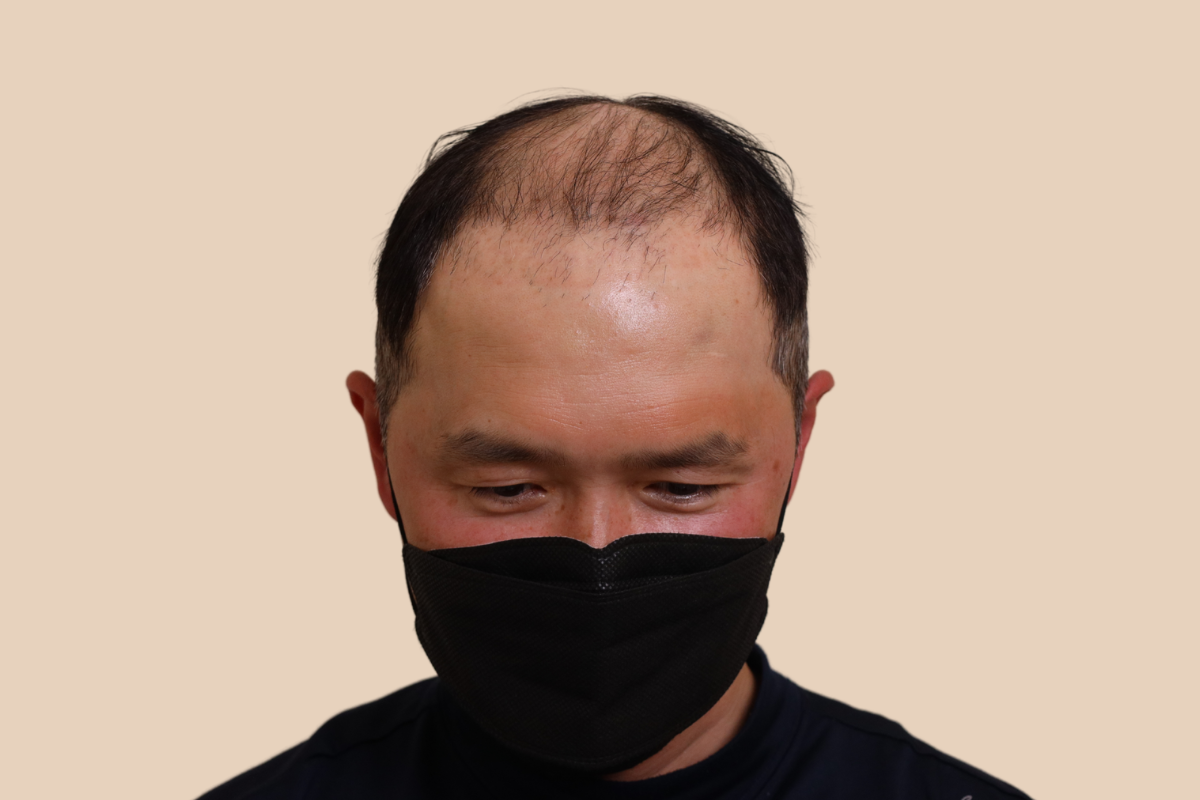삭발디자인 시술 전