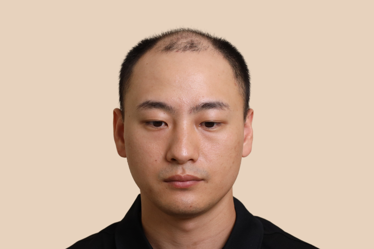 삭발디자인 시술 전