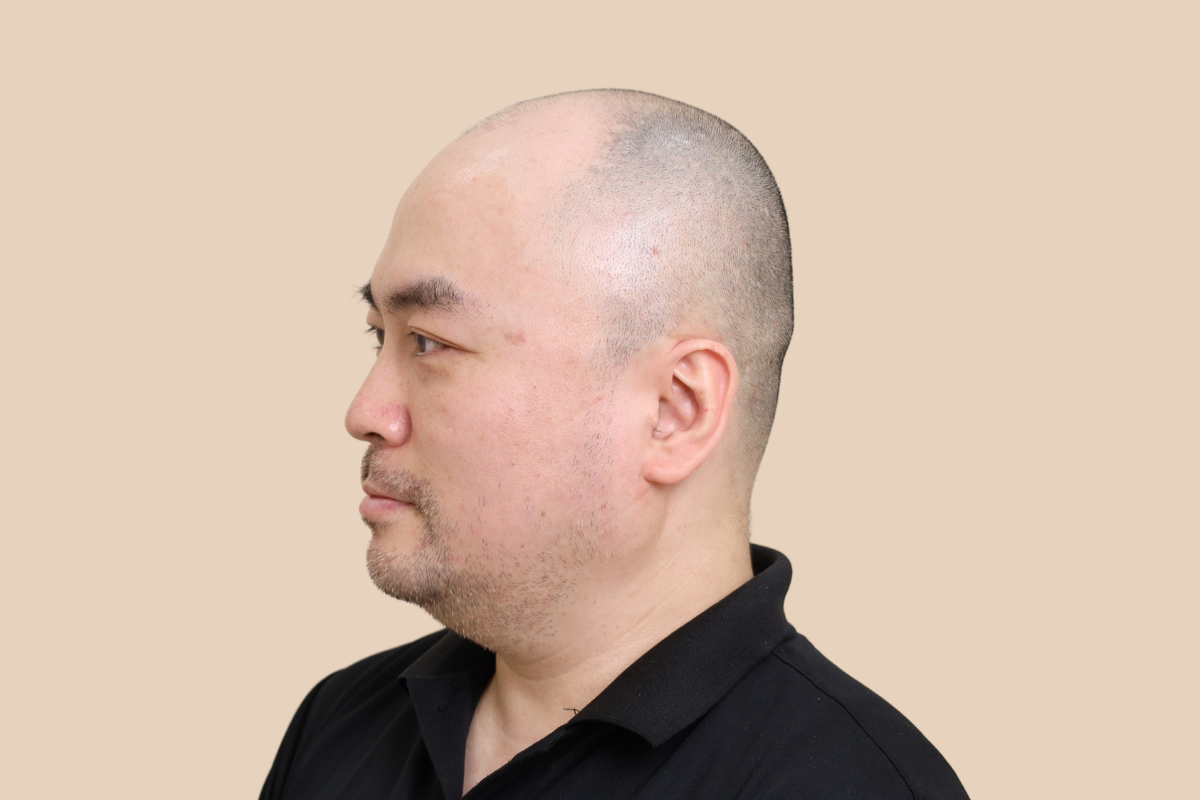 삭발디자인 시술 전