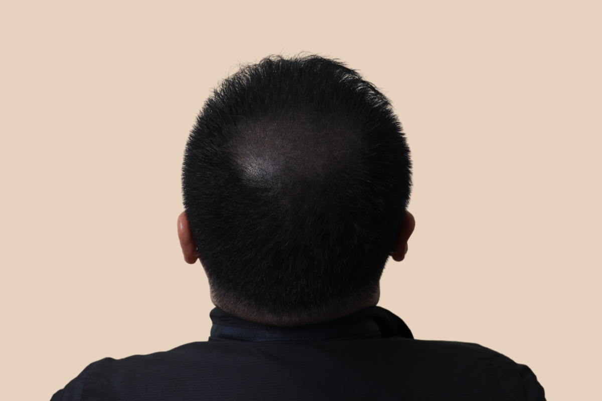 정수리 시술 후