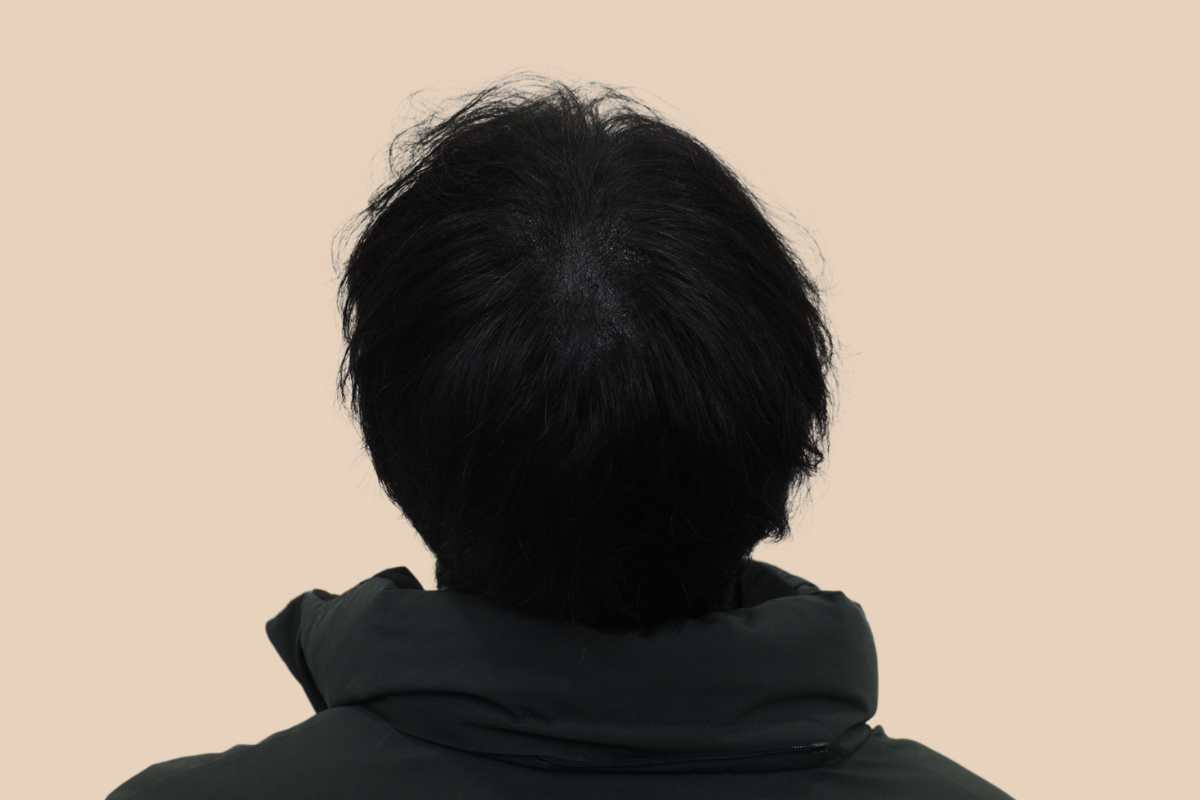 가르마 · 정수리 3회 시술 후
