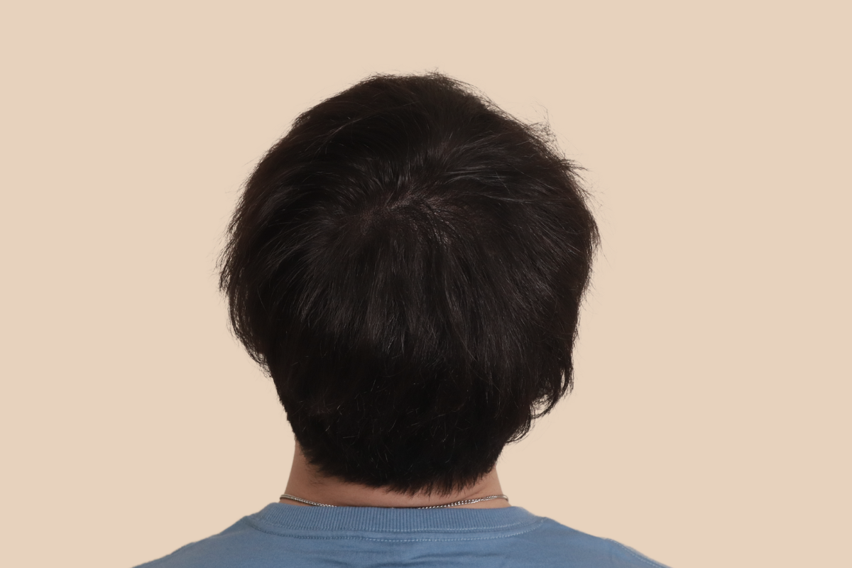 가르마 · 정수리 4회 시술 후